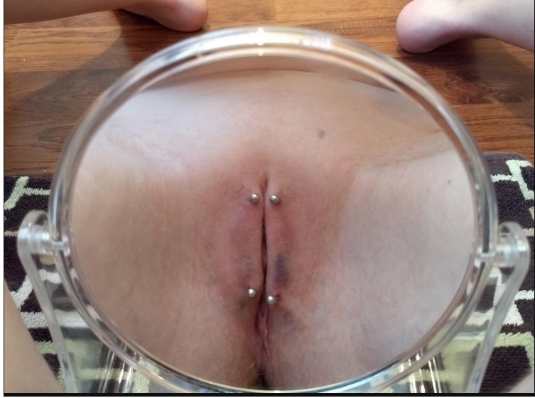 Vaginal chastity — 12