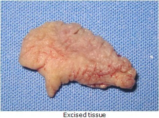 Vaginal mutilation — 7